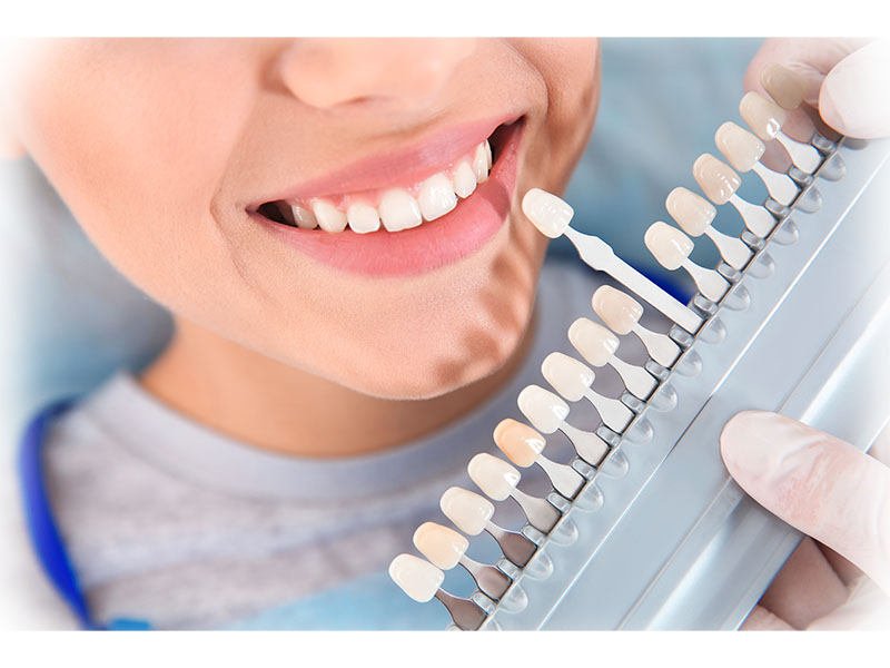 Dentist matching a teeth shade on a colour guide during whitening consultation