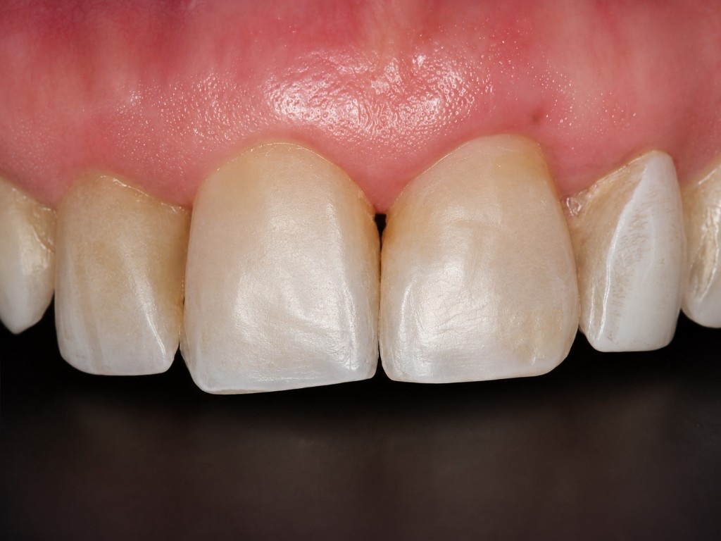 After Chao Pinhole Surgical Technique: restored upper gumline covering previously exposed roots
