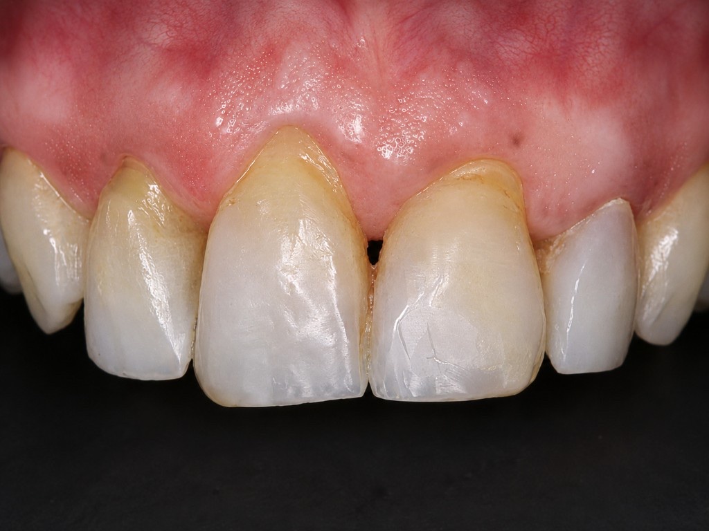 Before Chao Pinhole gum surgery: upper front teeth with gingival recession and exposed roots