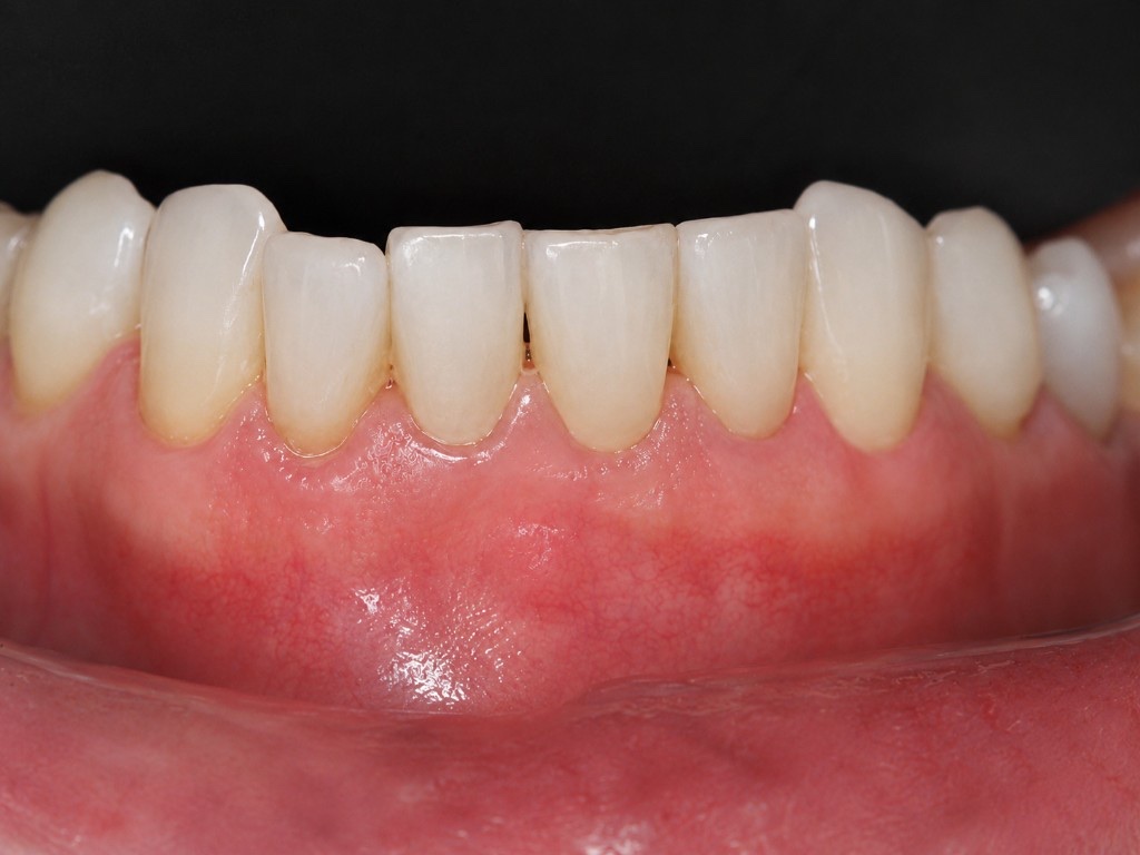 After Pinhole Surgical Technique: healthy lower gumline with covered roots and filled papillae