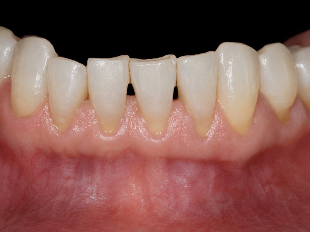 Before Pinhole gum recession treatment: lower front teeth with receded gums and black triangles
