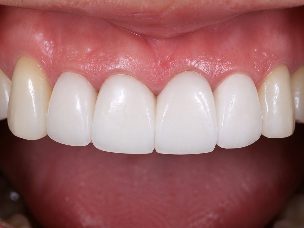 After Chao Pinhole procedure: even pink gumline covering upper front tooth roots