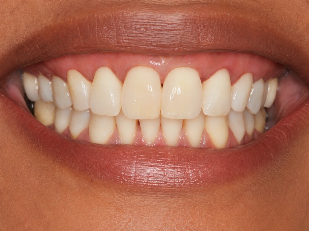 After Pinhole gum surgery: natural-looking restored gum coverage on the upper front teeth