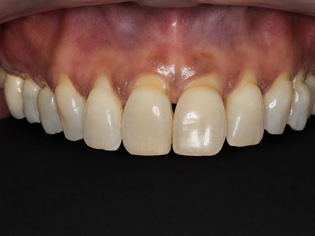 Before Chao Pinhole Surgical Technique: upper teeth with uneven gum recession and root exposure