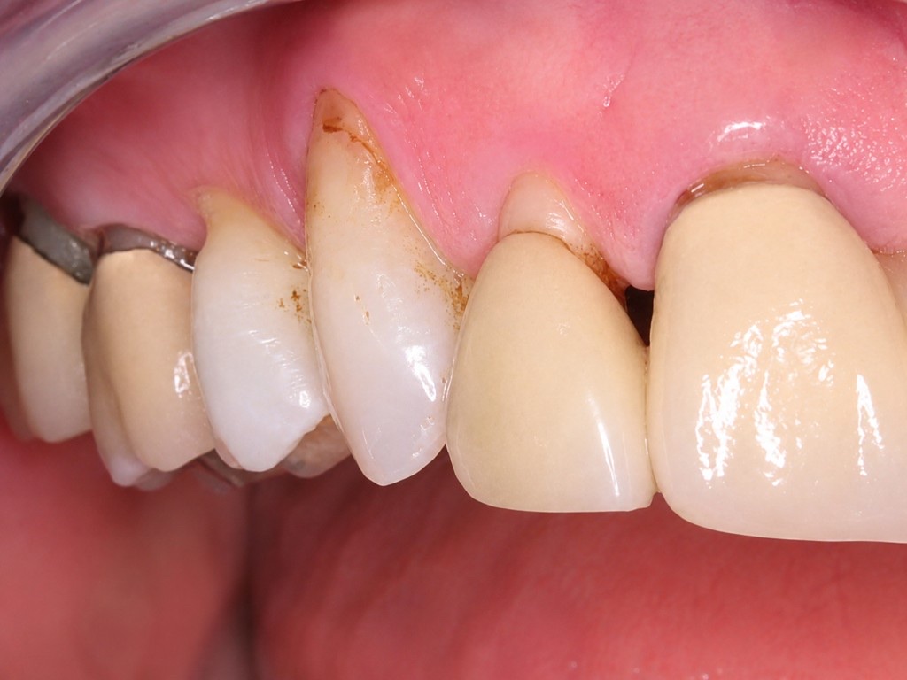 Before Pinhole Surgical Technique: side view of upper teeth with severe gingival recession and exposed roots