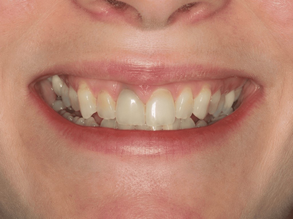 Professional teeth whitening — before