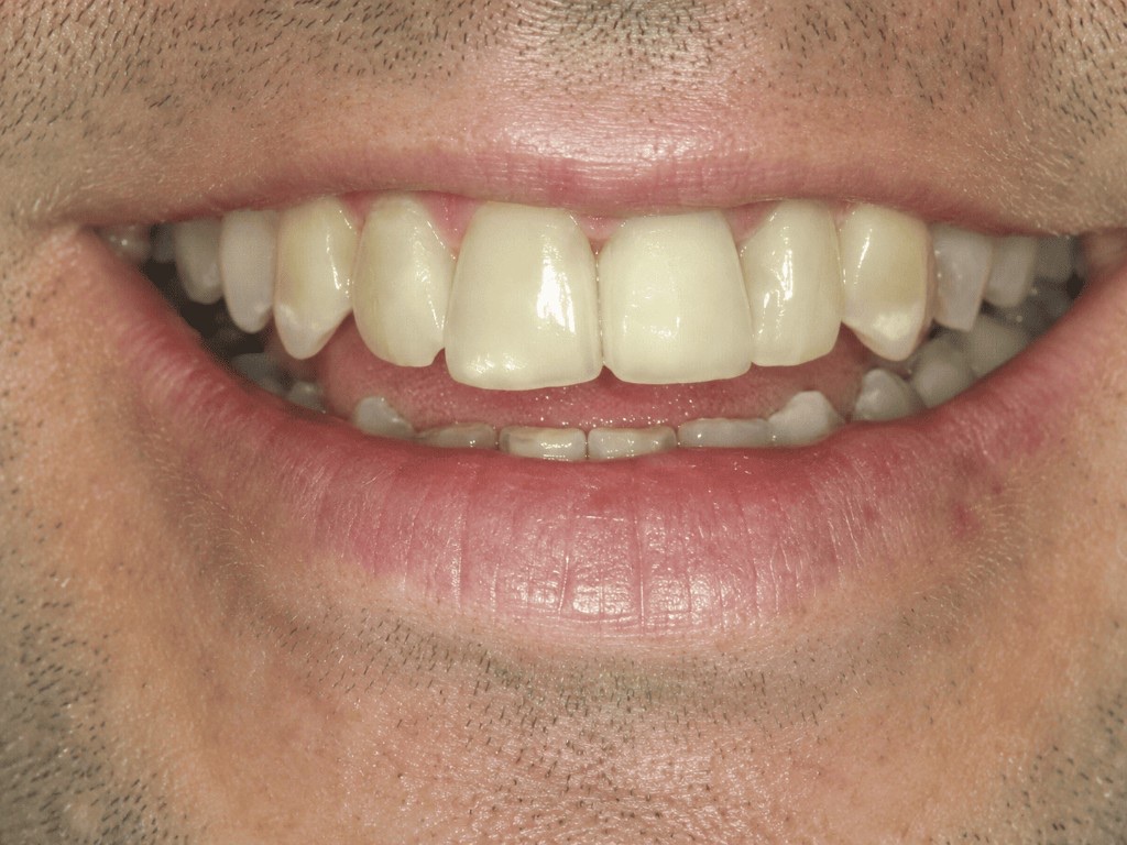 Porcelain veneers — before