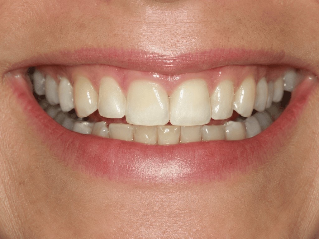 Complete smile makeover — before