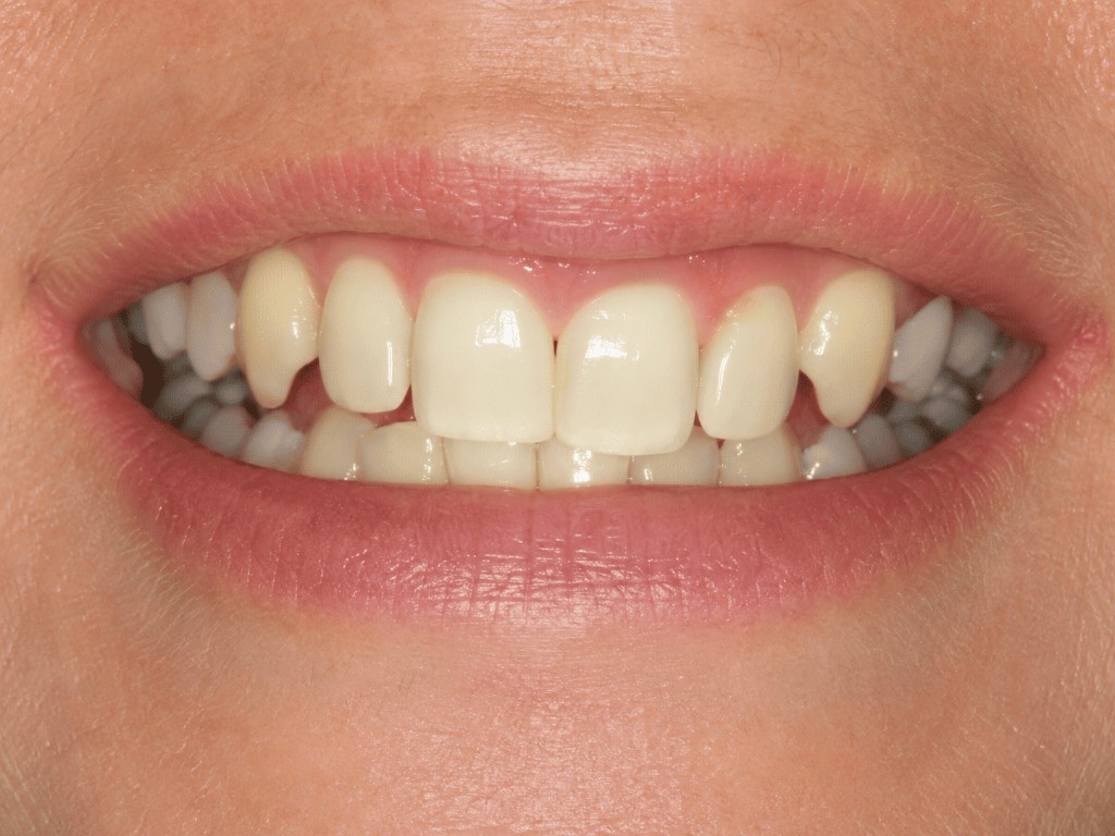 Dental implant restoration — before