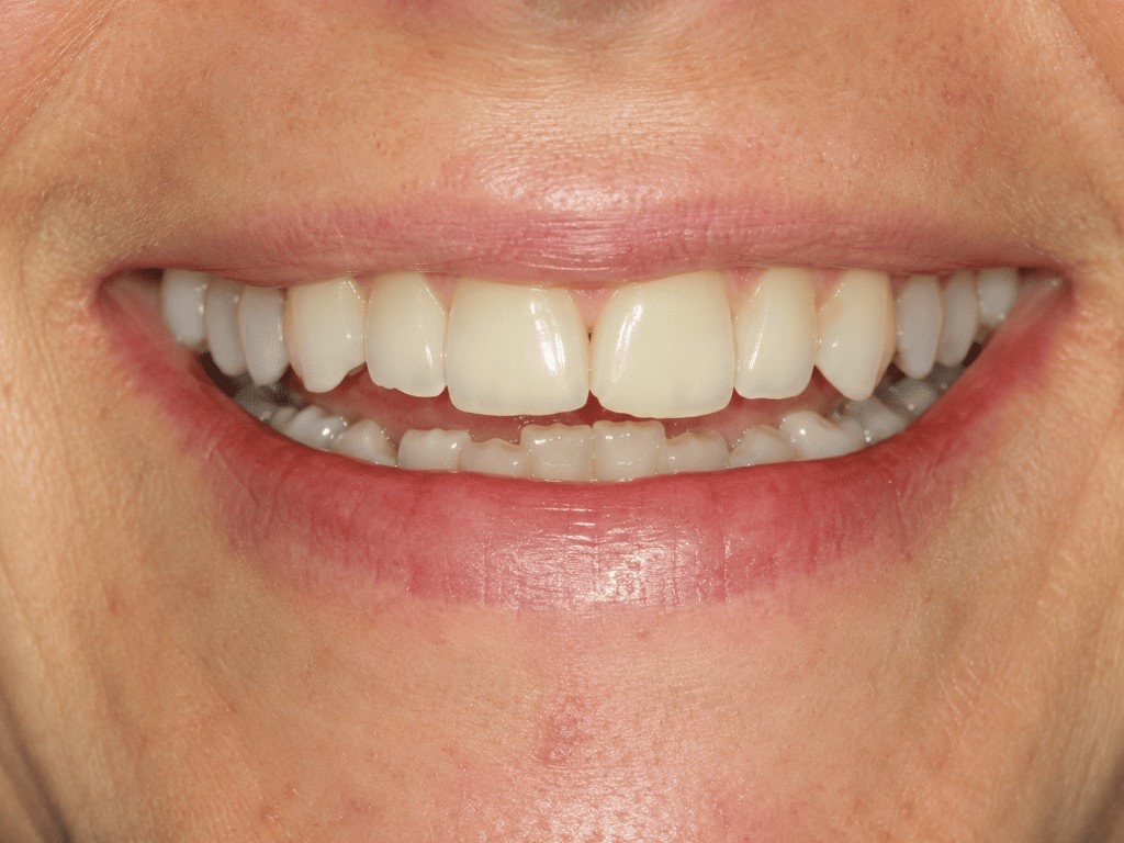 Cosmetic dental bonding — before